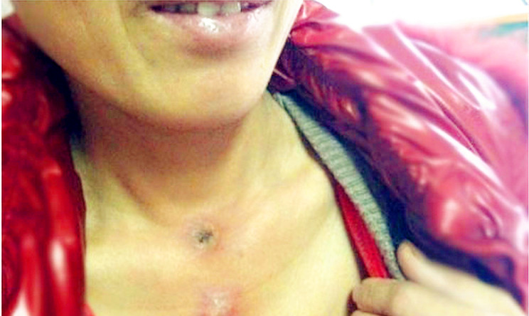 段女士：“肺腺癌”蜂疗案例