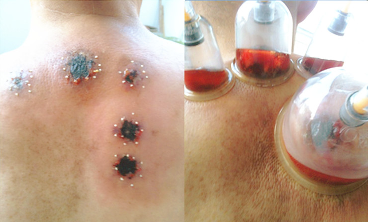 彭先生：“肺鳞癌”蜂疗案例