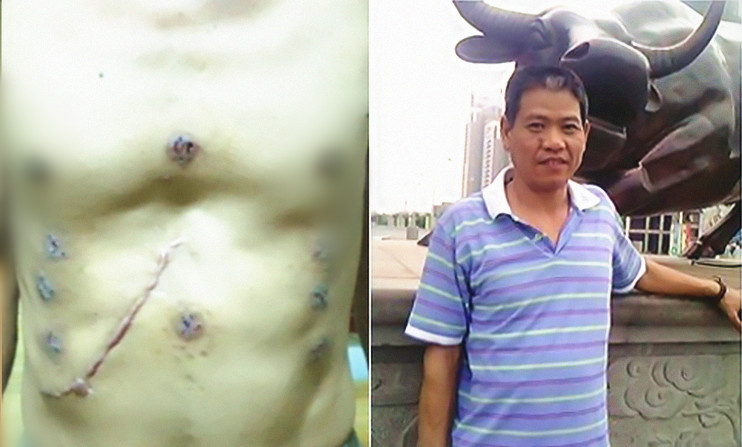 苏先生：“原发性肝癌”蜂疗案例