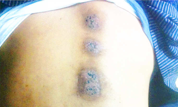 席先生：“肝癌”蜂疗案例