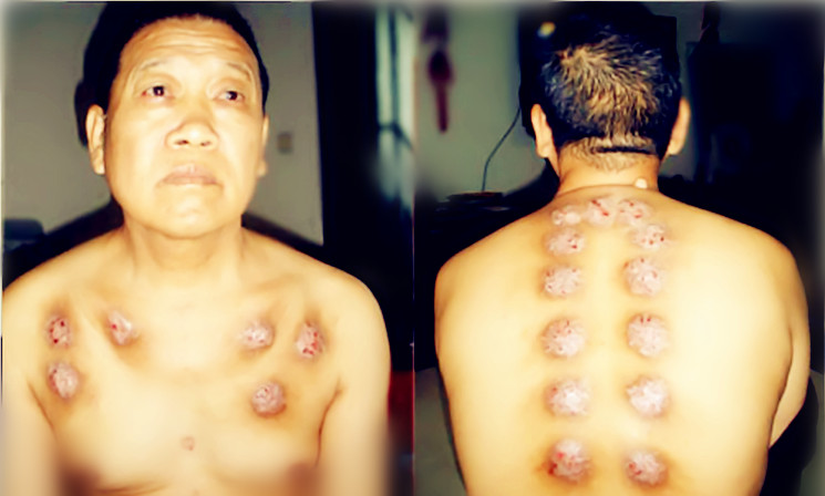 曾德文：“晚期肺腺癌”蜂疗案例