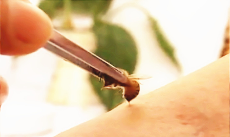 张先生：“肺癌”蜂疗案例