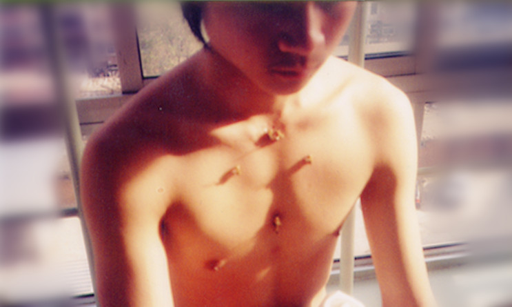 张扬：“哮喘”蜂疗案例