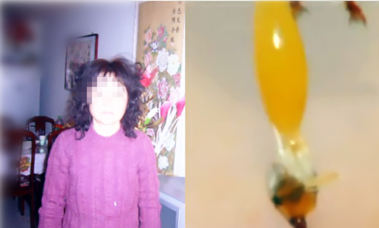 周女士：“食管癌腹膜淋巴转移”患者蜂疗案例