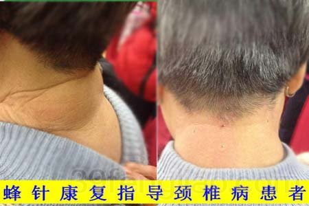 杨志刚蜂疗颈椎病患者