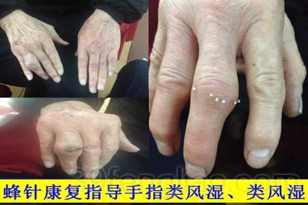 蜂针类风湿