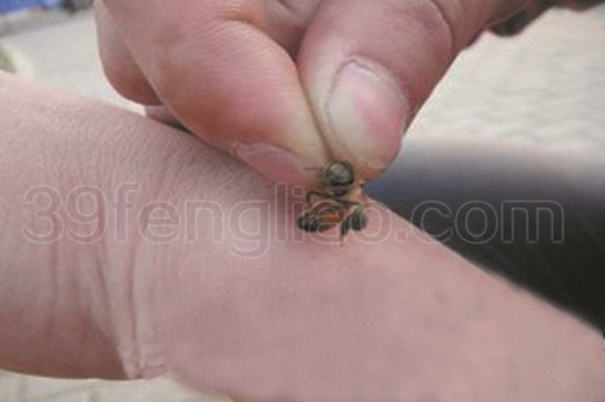 专家深度解读之点刺法