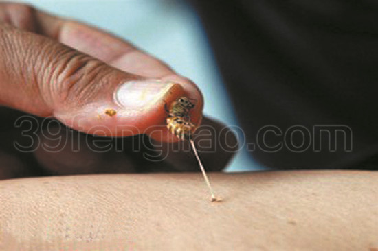 专家深度解读之散刺法