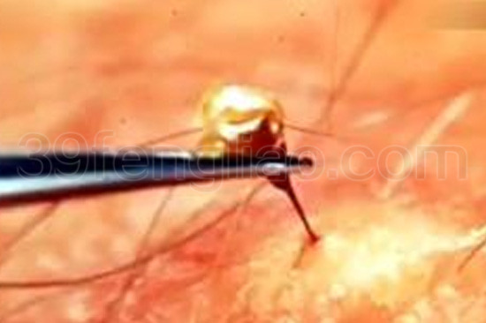 蜂毒对抗艾滋病最新报道