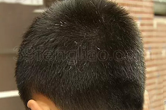 蜂王浆防治白发原理