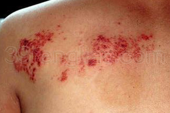 带状疱疹及其后遗症的中西医治疗与辩证蜂疗