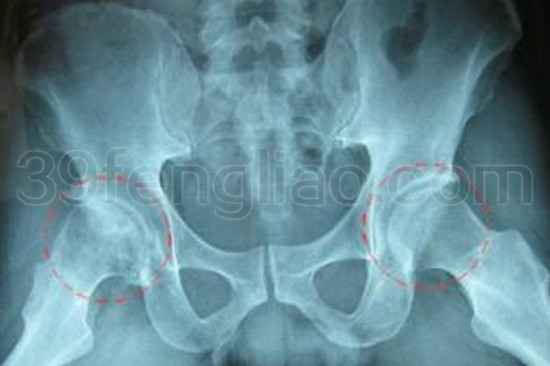 股骨头坏死辩证疗法