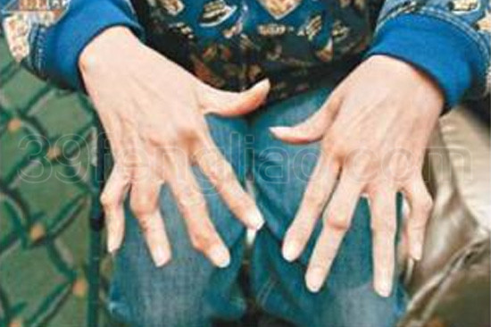 蜂灸疗法对类风湿性关节炎的疗效观察