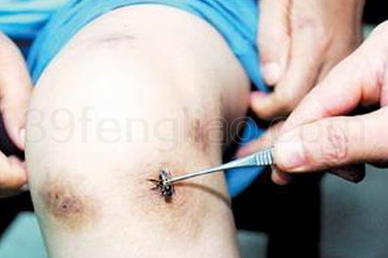 蜂针严重过敏反应及防治的探讨