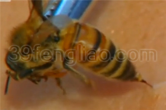 蜂针疗法蜂疗