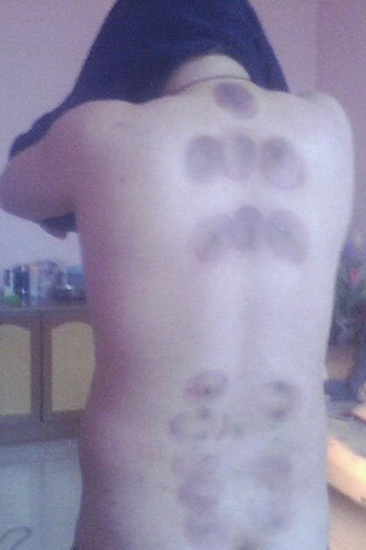 蜂疗治疗癌症-39蜂疗网