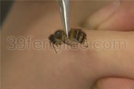 39蜂疗网，蜂疗，蜂疗治疗强直性脊柱炎