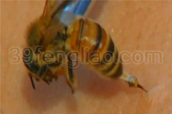 蜂毒疗法不等于蜂疗，39蜂疗网带你了解两者不同之处