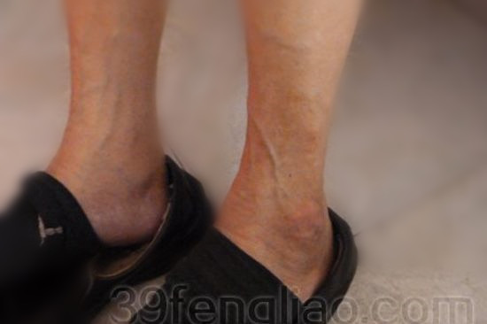 39蜂疗网，蜂疗