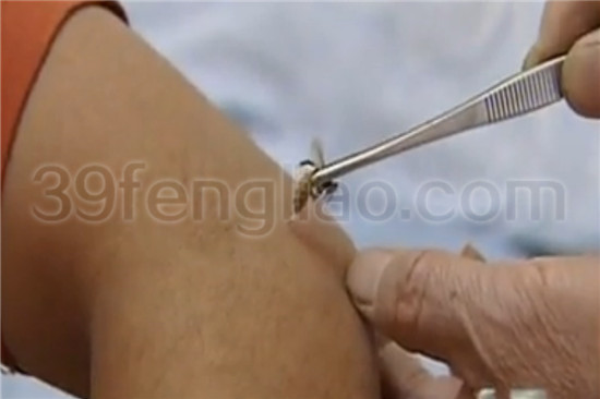 39蜂疗网,蜂疗治疗颈椎病