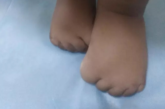 苏丹2岁脑瘫患儿接受ReLife国际医疗中心治疗