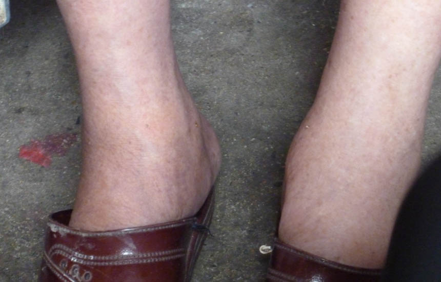 陈伯坤老人治疗前双腿肿胀