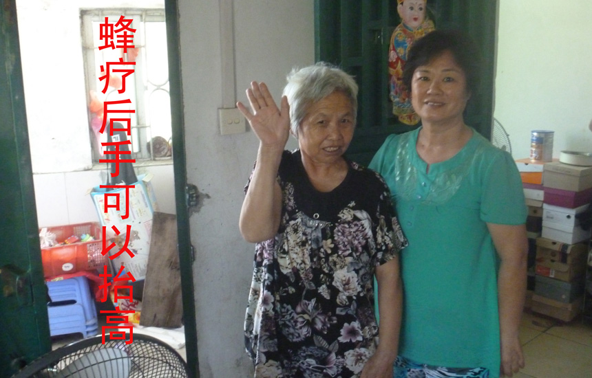 乳腺癌患者彭大姐蜂疗后手可以抬高