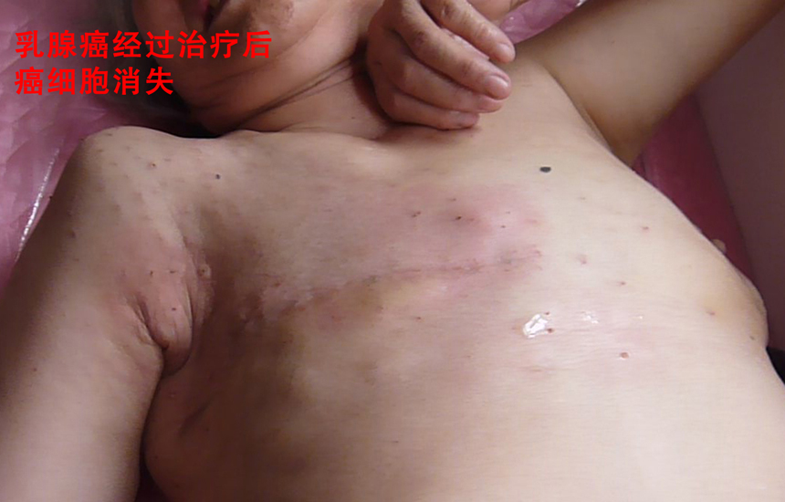 乳腺癌经过治疗后癌细胞消失