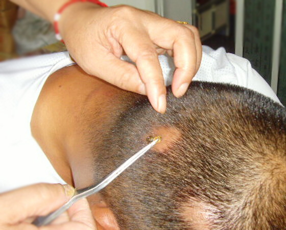 斑秃患者,蜂疗前2