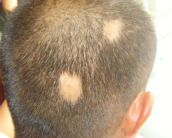 斑秃患者,蜂疗两月后痊愈