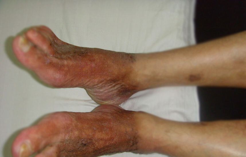 末梢神经炎,多家医院建议双截肢患者.经蜂疗五个疗程,正在康复过程中