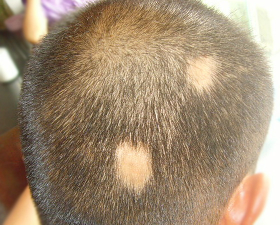 斑秃患者,蜂疗前1