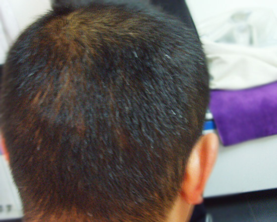 斑秃患者,蜂疗两月后长出浓黑头发