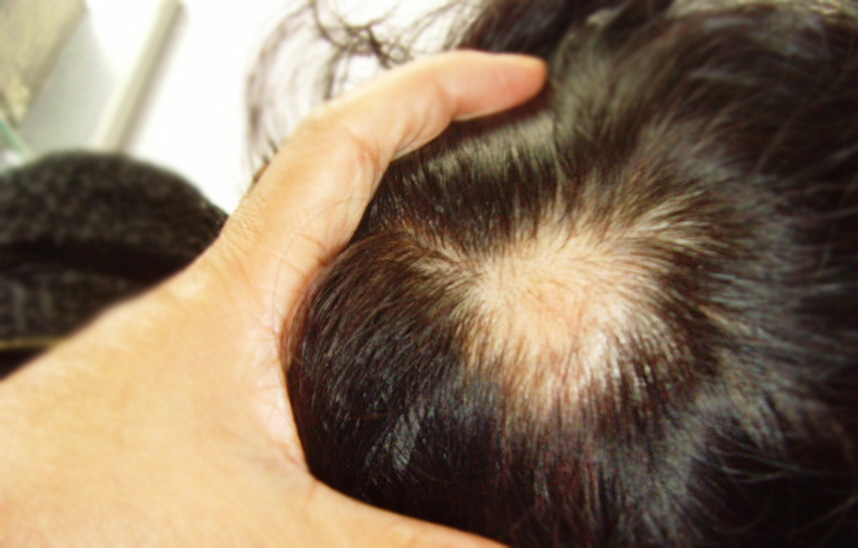 油脂性脱发患者,女,50岁.丹阳市开发区.蜂针治疗一个月后痊愈