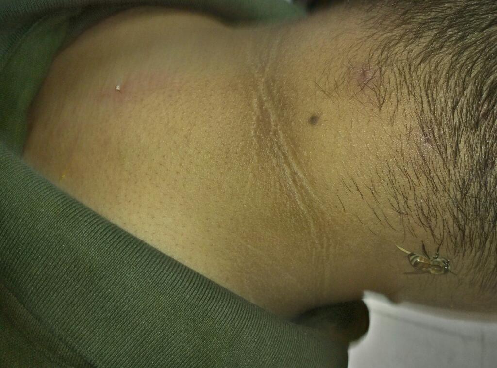 感冒患者蜂疗治疗中