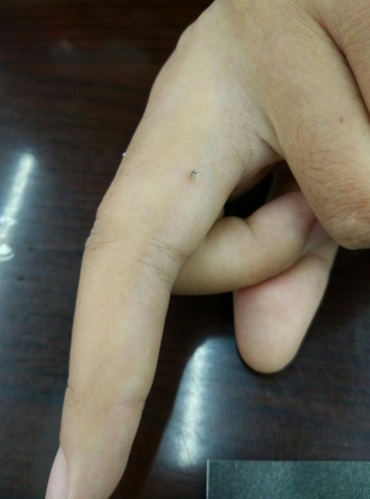 手指关节炎患者蜂疗中