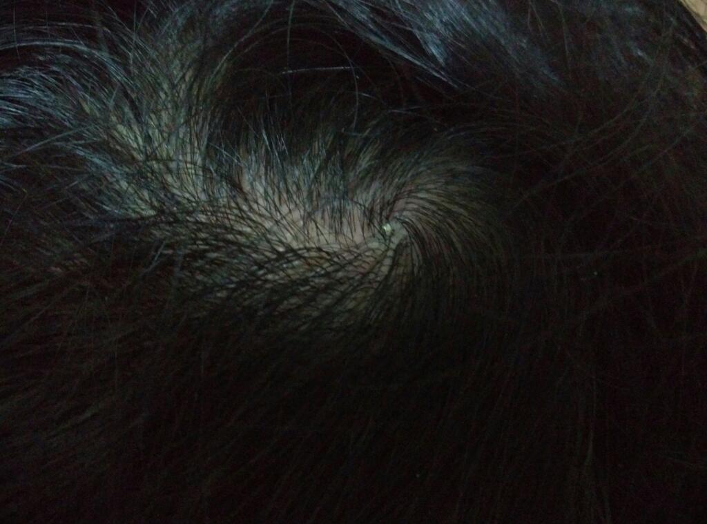 头疼患者治疗中