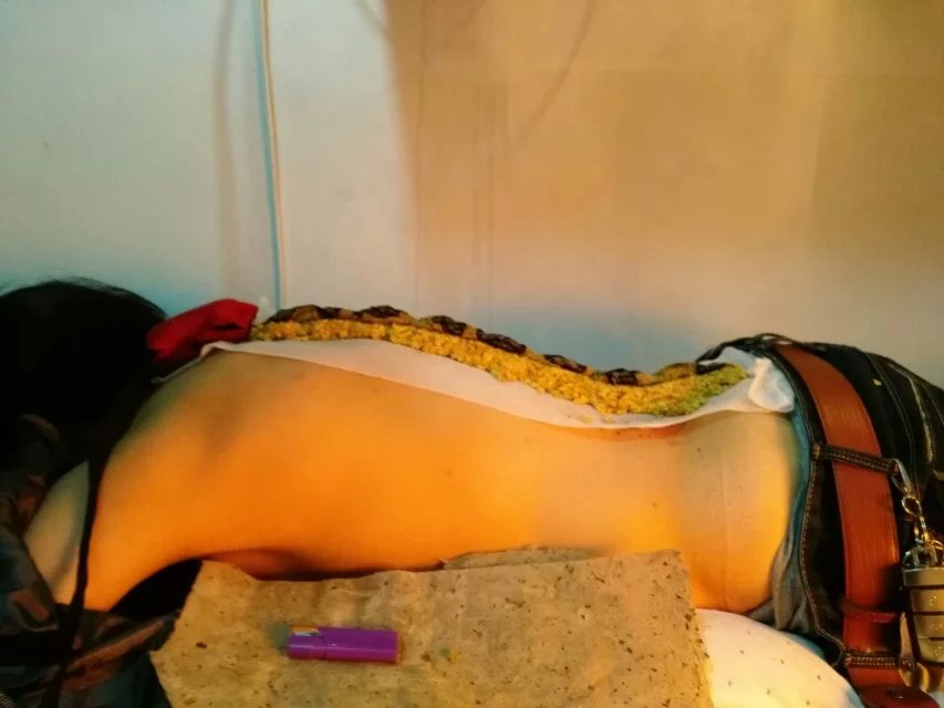 黄氏中医的家传绝技，督灸。