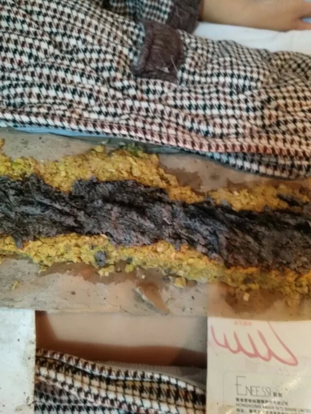 黄氏中医的家传绝技，督灸。