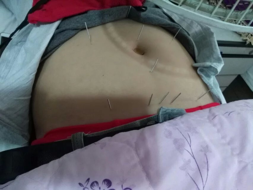 腹针。调理脏腑气机是极好的！