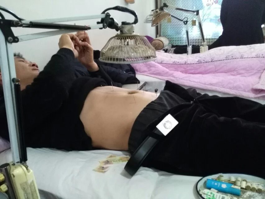 腹针。调理脏腑气机是极好的！