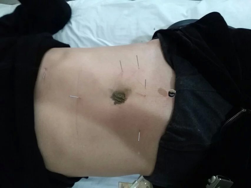 腹针。调理脏腑气机是极好的！