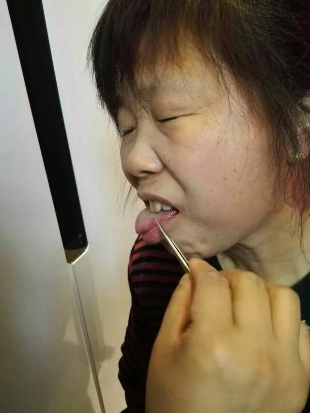 为一名舌头发麻的患者蜂针。