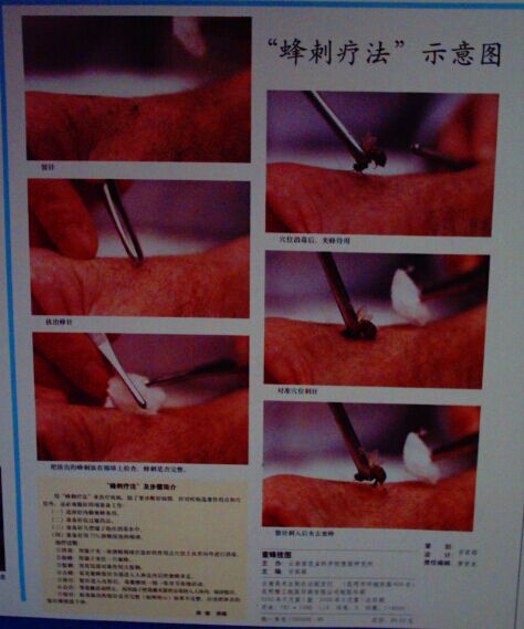 蜂刺疗法做法
