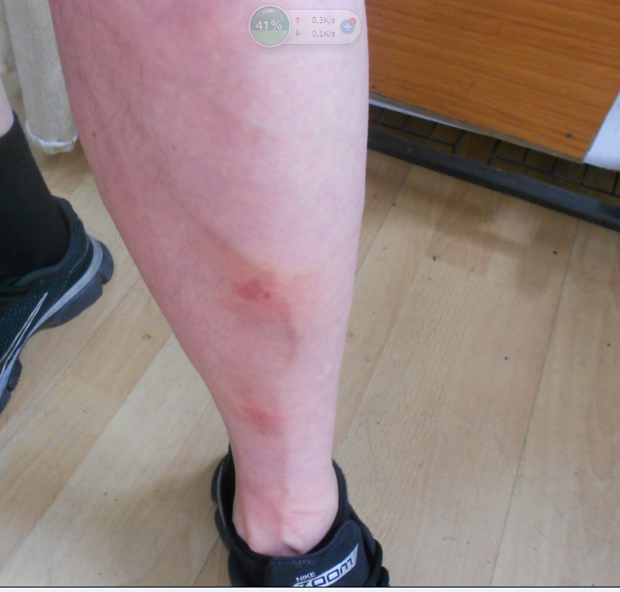 静脉曲张治疗后