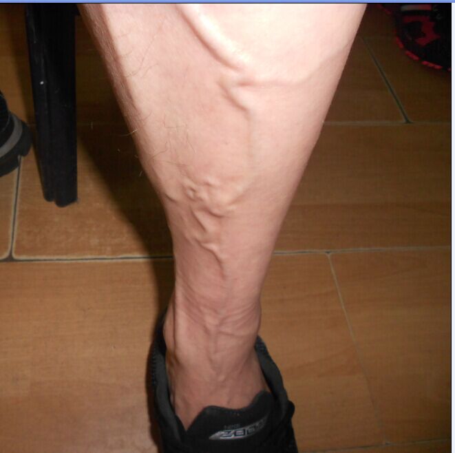 静脉曲张治疗前