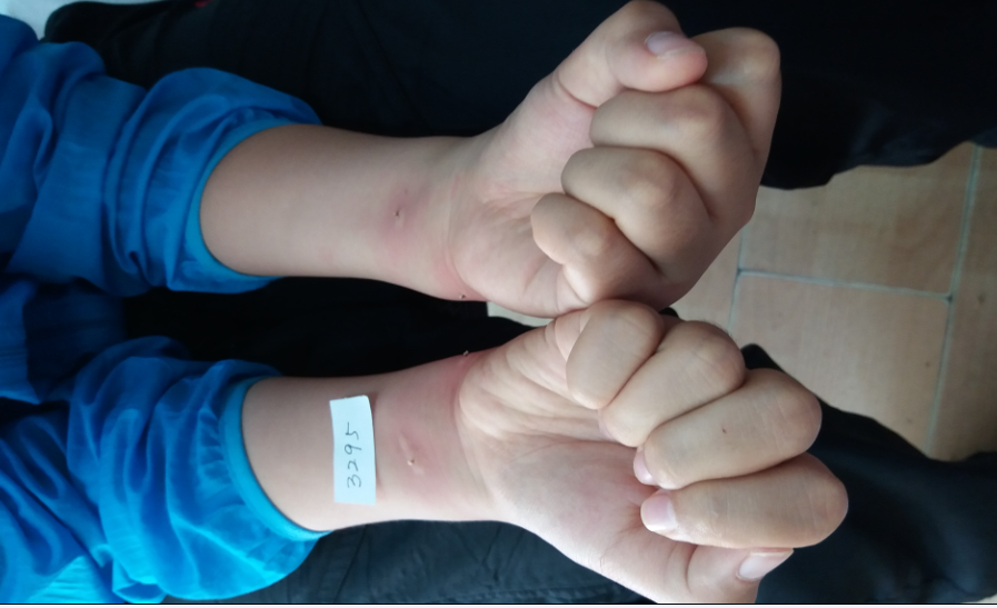 6月22日来我们诊所用蜂刺疗法治疗时，心情也很好，说记忆增强更好了，但是上次肿的厉害，反应较大，刚好。