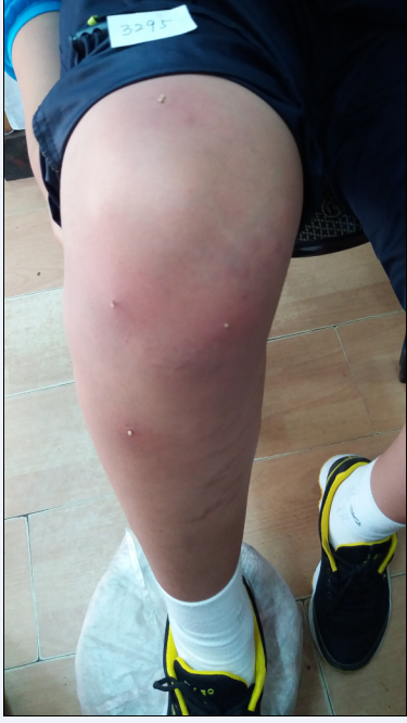 7月2日蜂刺73点2个、75点2个、右腿双膝眼、79点