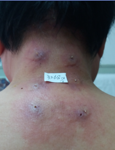 3268 王桂英 2016-11-12 继续治疗