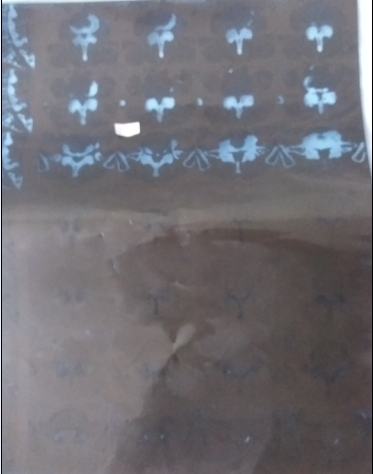 3322 刘玉晶 67岁 2016-11-12 初诊 2012-01-10在大连大学附属中山医院CT检查